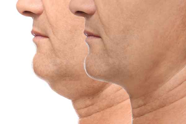 HIFU - Breakthrough in Anti - ageing 2 hifu results Harefield