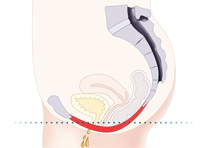Pelvic-Floor Muscle Repair 5 Pelvic floor muscles Harefield