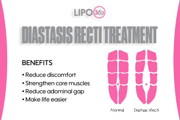 Revolutionising Muscle Repair: The Power of LIPO360 Body Sculpt Post-Injury 5 diastasis recti treatment Harefield