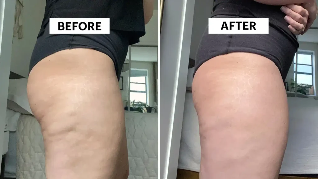Sculpting Your Bum: Can Toning Exercises Really Reduce Cellulite? 1 Do Toning Exercise Harefield Really Tackle Cellulite?