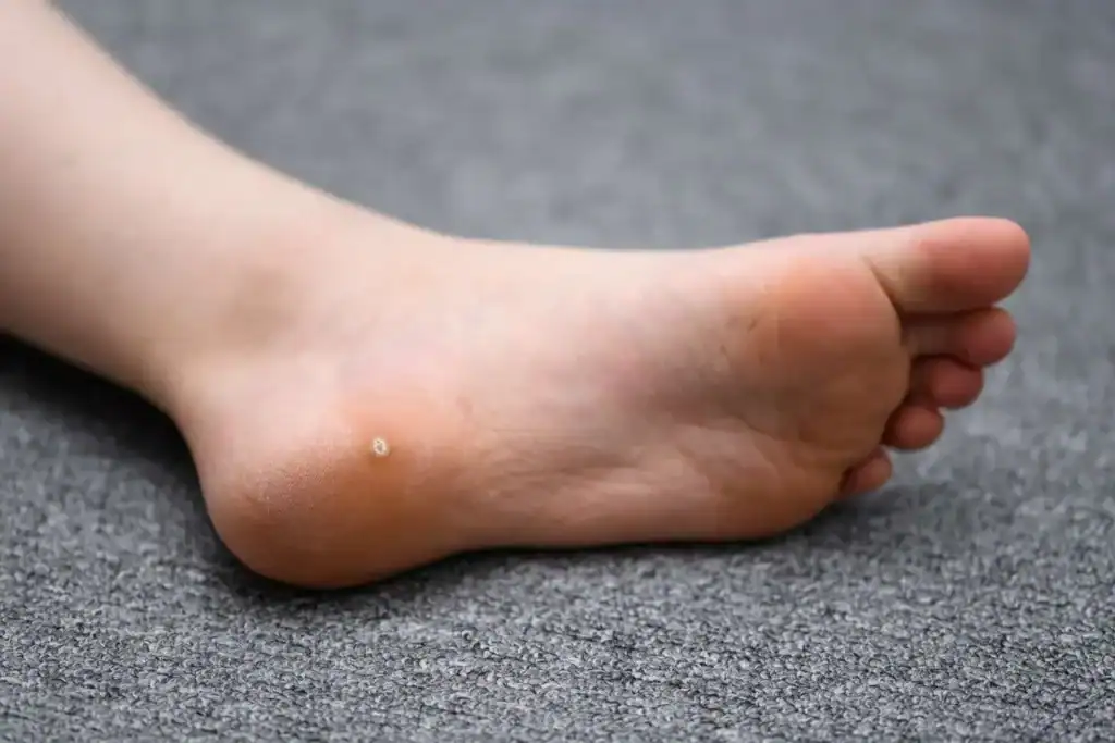Cryotherapy For Warts And Also Verrucas 2 Image of verruca on the bottom of the foot that able to be treated with Cryotherapy Harefield