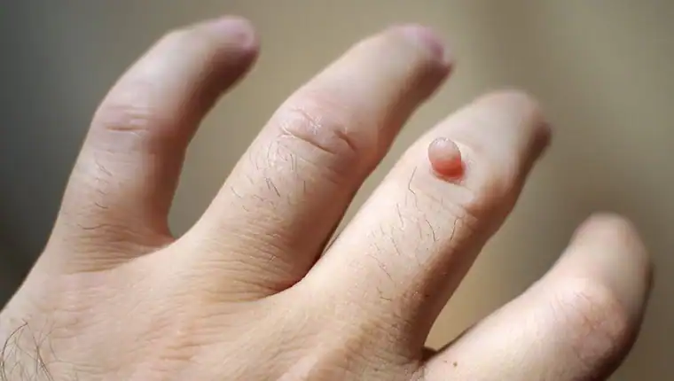 Cryotherapy For Warts And Also Verrucas 1 Image of blemish that Cryotherapy Harefield can remove with Lipo 360.
