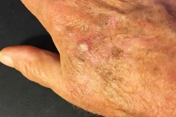 Cryopen For Actinic Keratoses 1 Image of Actinic keratoses Harefield on a person hand
