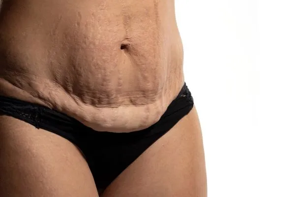 The Science of Skin Tightening 1 The science behind skin tightening Harefield picture of a woman's sagging skin on the stomach